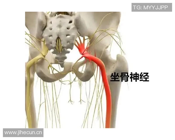 专家解读坐骨神经痛成因及治疗方法大多数患者可避免手术治疗
